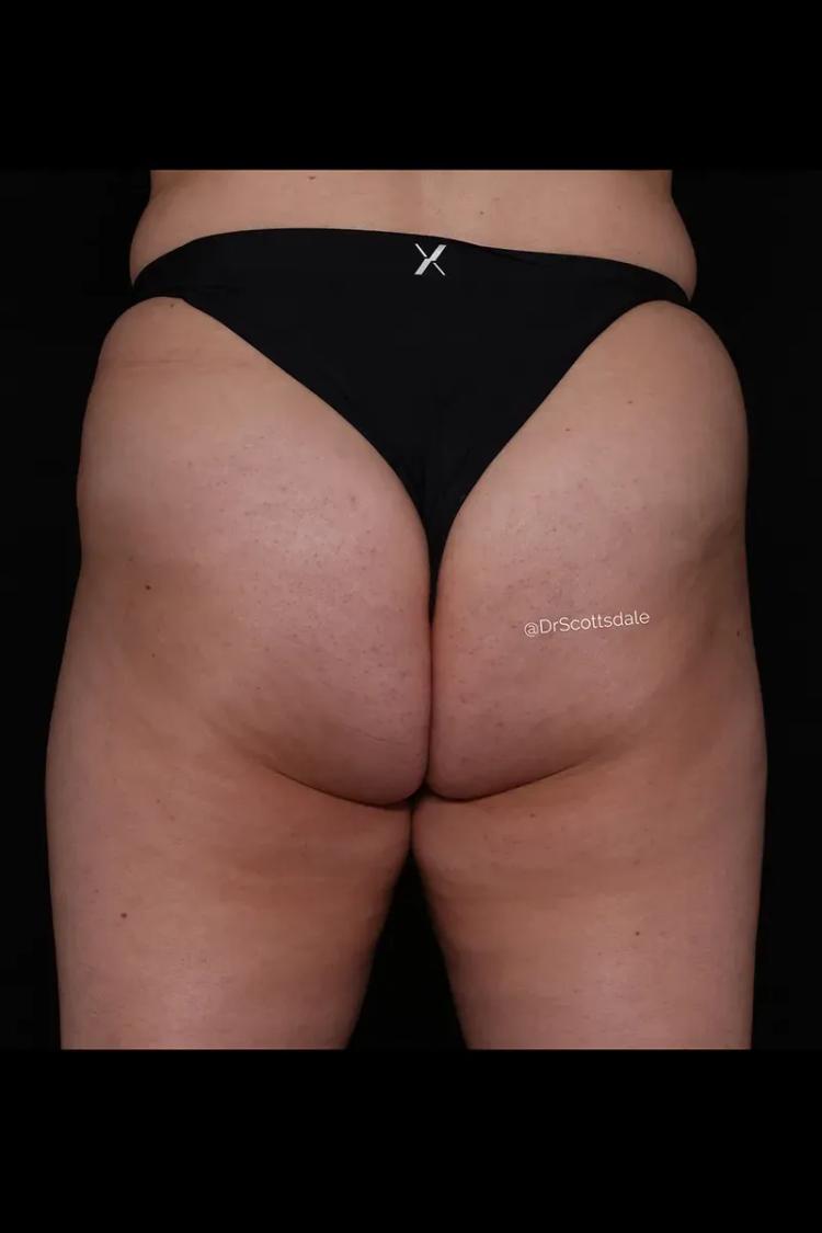 Lipedema after