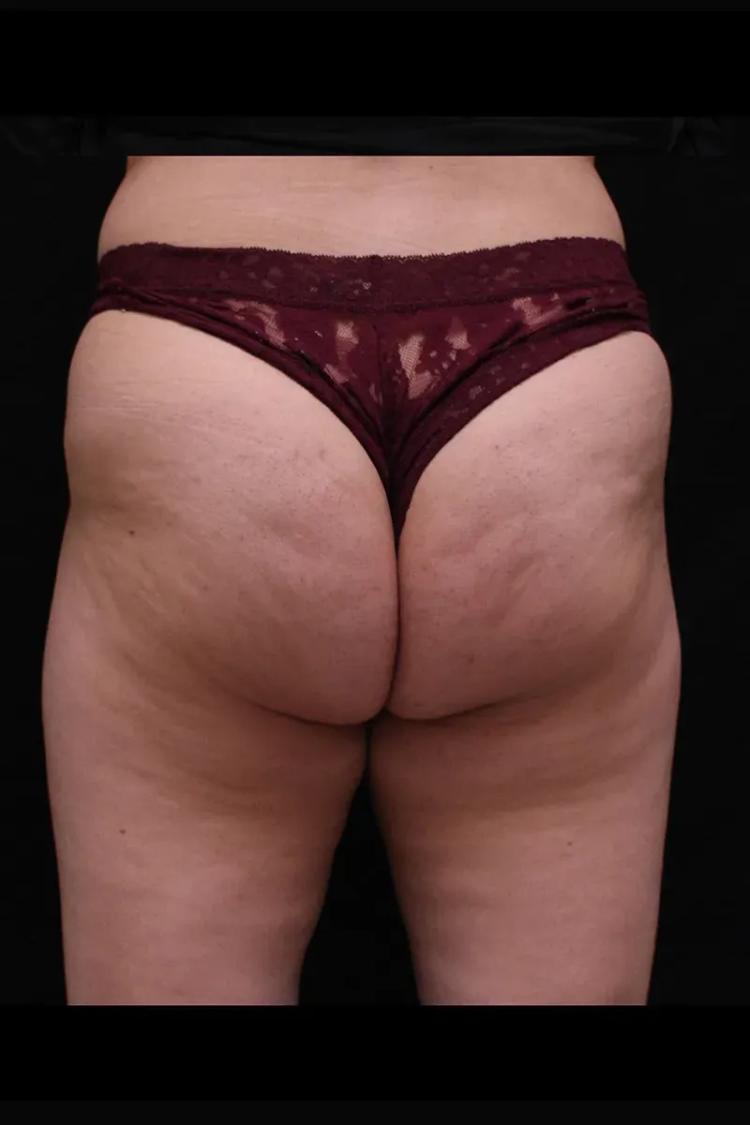 Lipedema before
