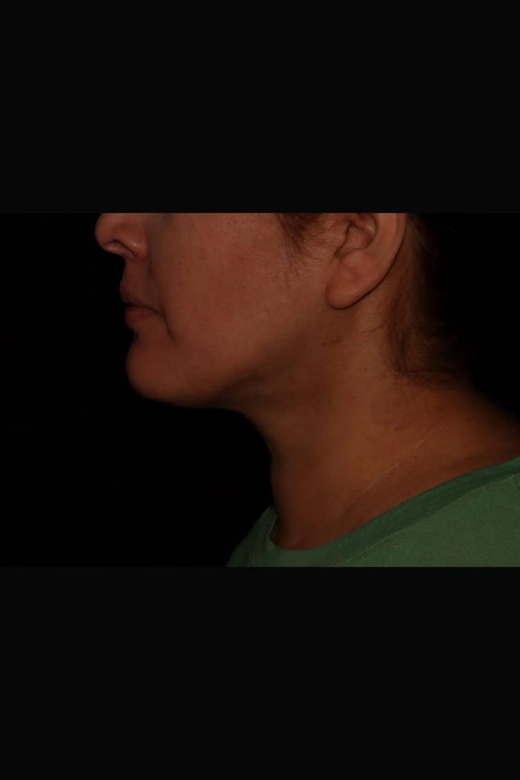 Buccal Fat Pad Removal, view 3, after