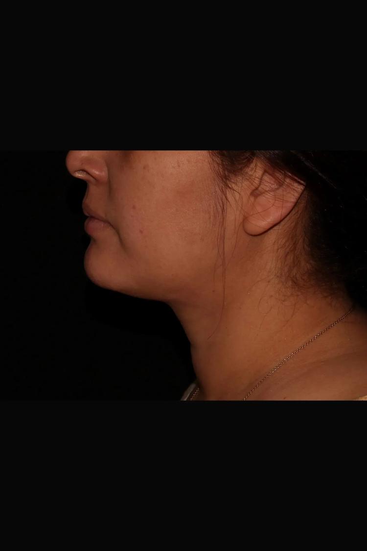 Buccal Fat Pad Removal, view 3, before