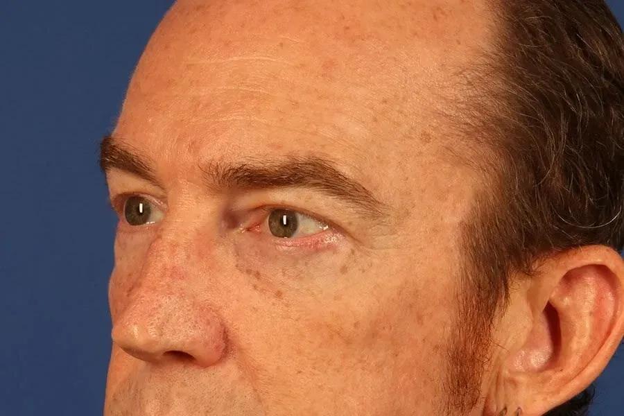 Eyelid Surgery, view 2, after