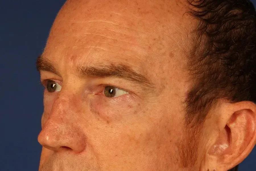 Eyelid Surgery, view 2, before
