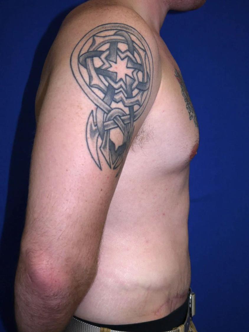 Tummy Tuck, view 3, after