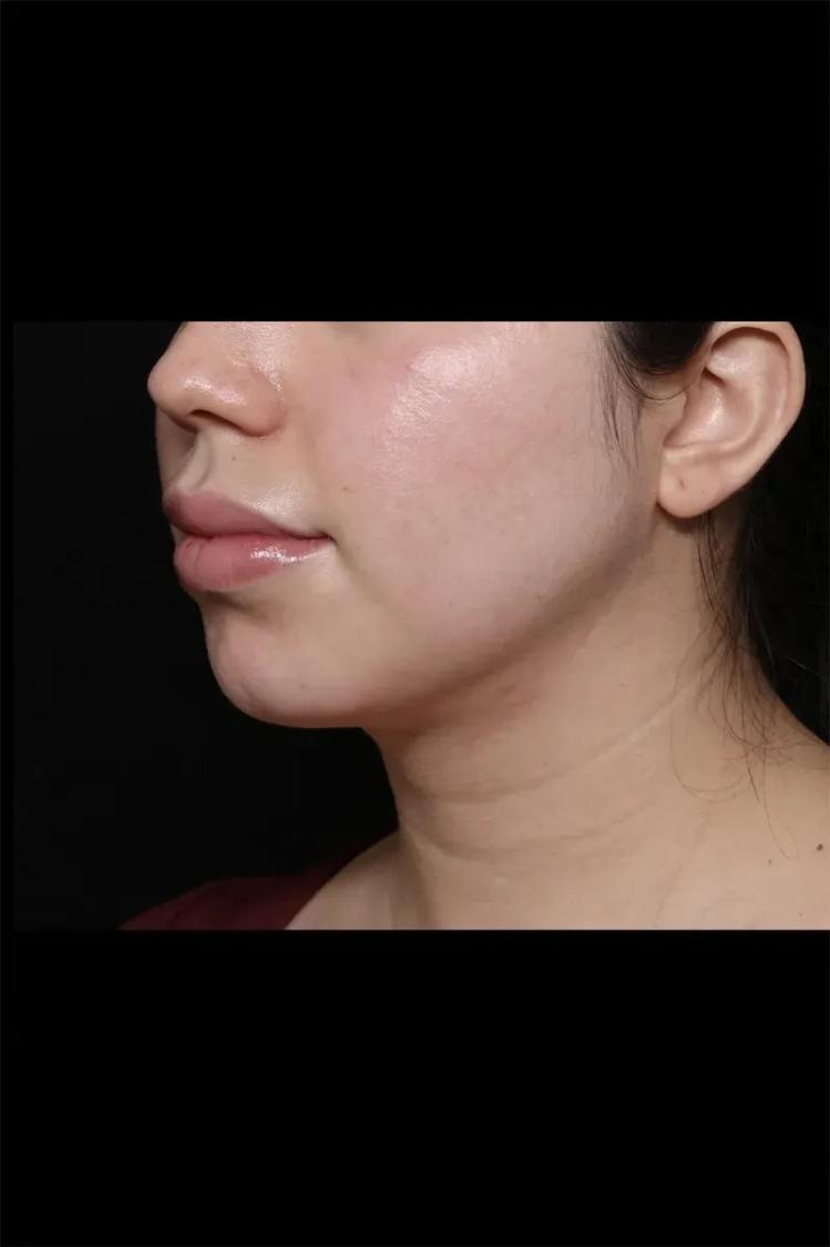 Buccal Fat Pad Removal after