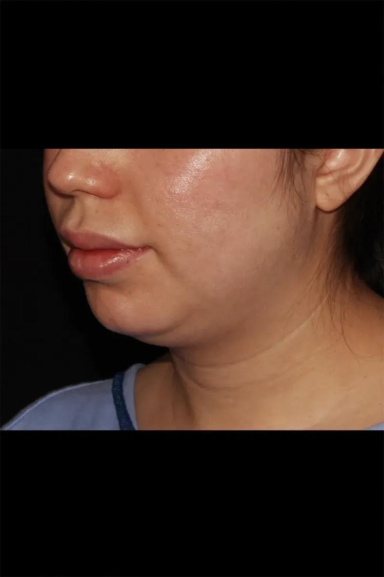 Buccal Fat Pad Removal before