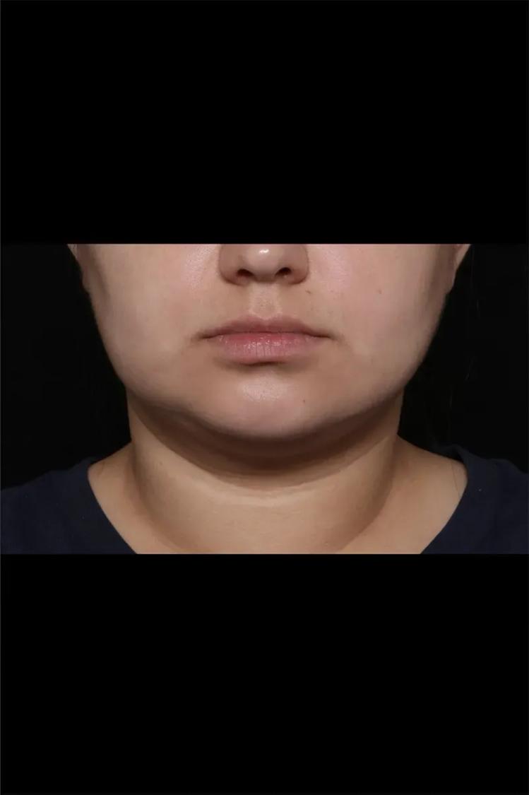 Buccal Fat Pad Removal after