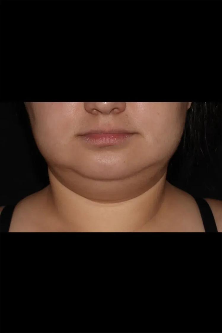 Buccal Fat Pad Removal before