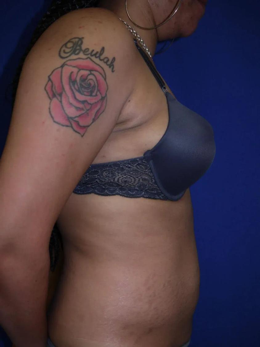 Tummy Tuck, view 2, after