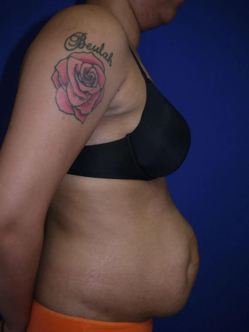 Tummy Tuck, view 2, before