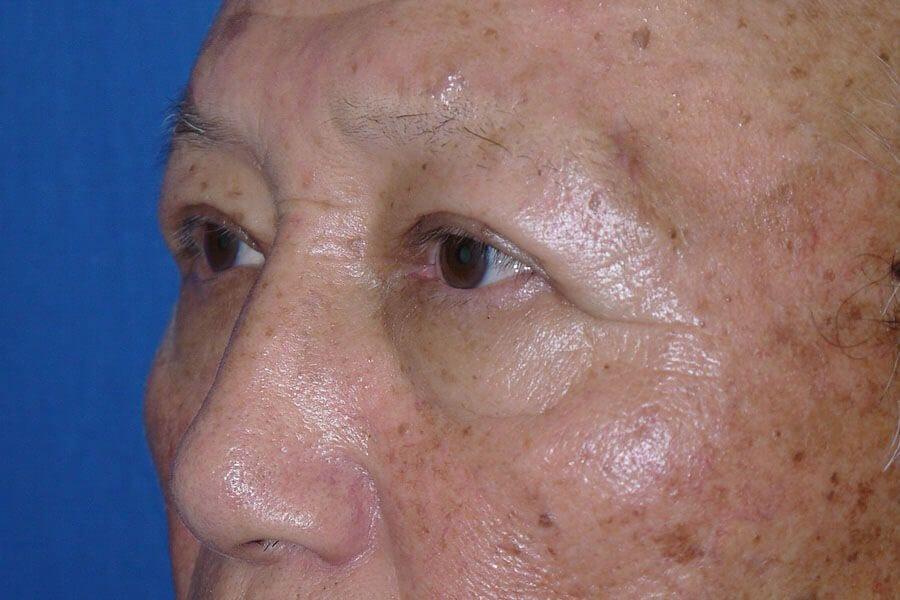 Eyelid Surgery after