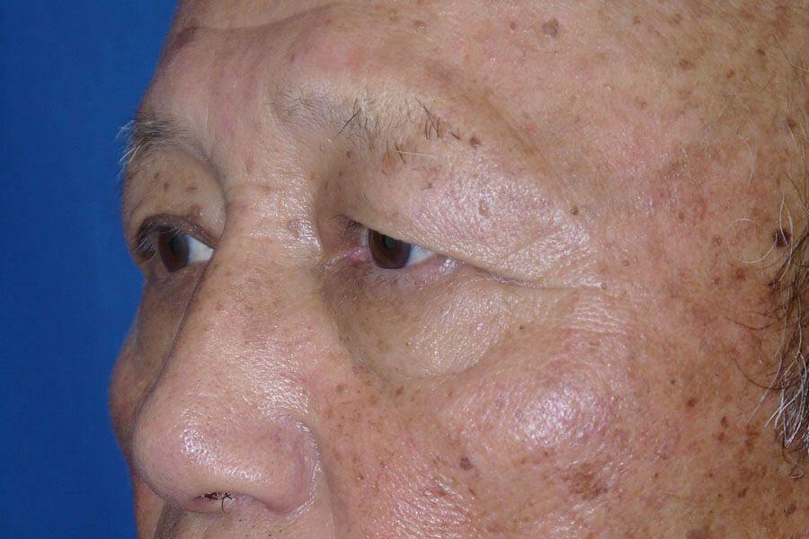 Eyelid Surgery before