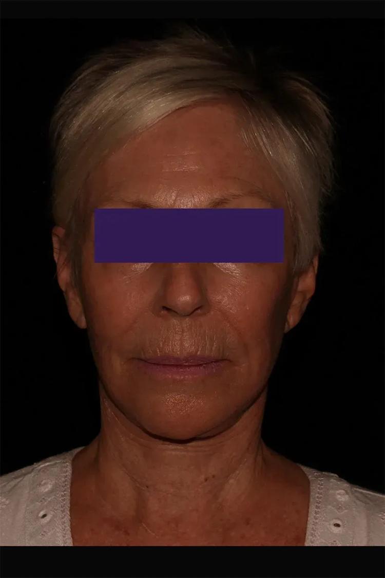 After Facelift (neck lift included)