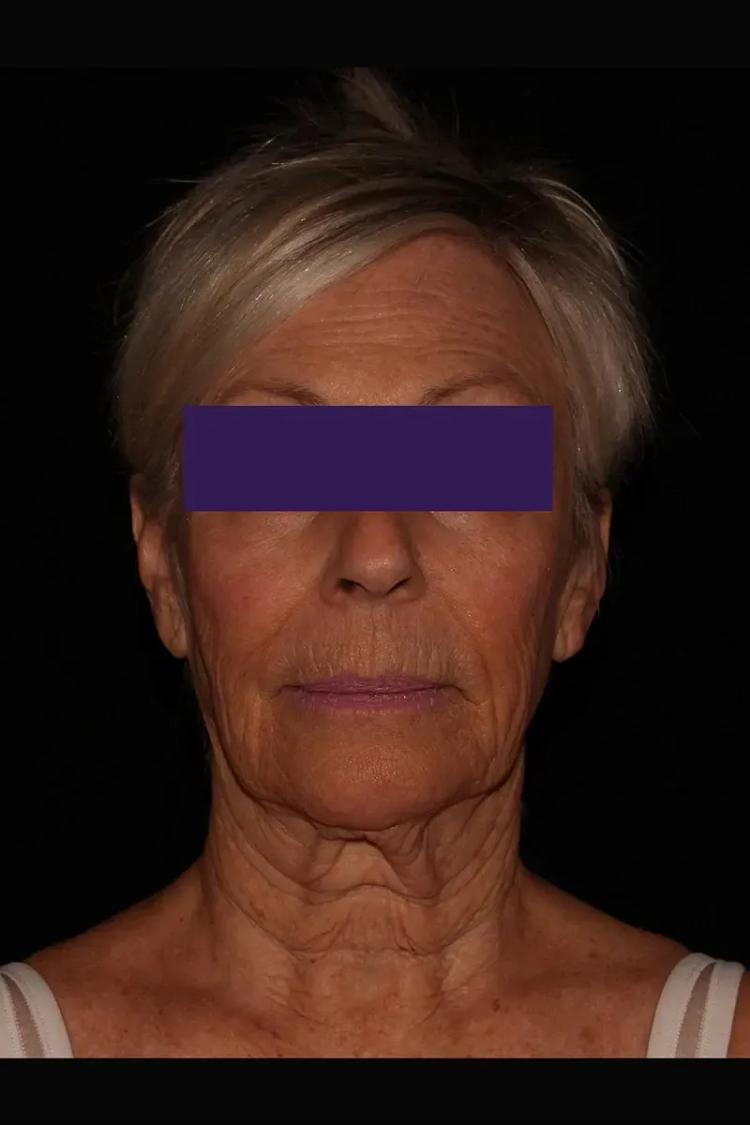 Before Facelift (neck lift included)