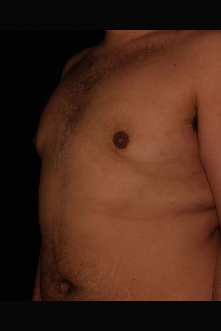 One-Stitch Gynecomastia after
