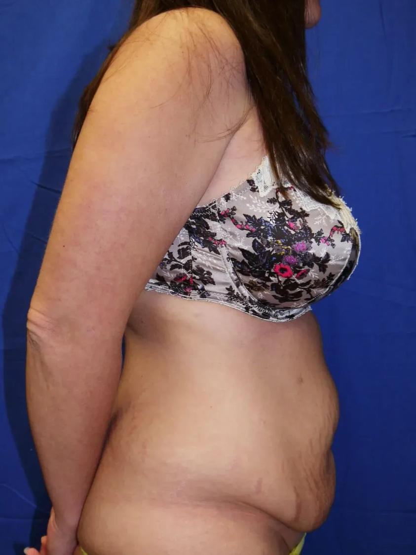 Tummy Tuck, view 3, before