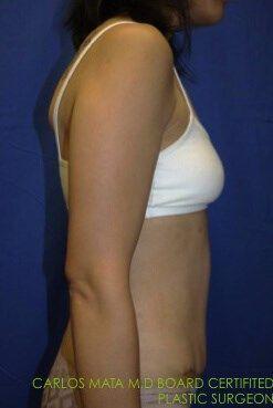 Tummy Tuck, view 3, after