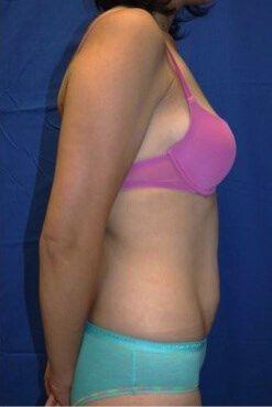 Tummy Tuck, view 3, before