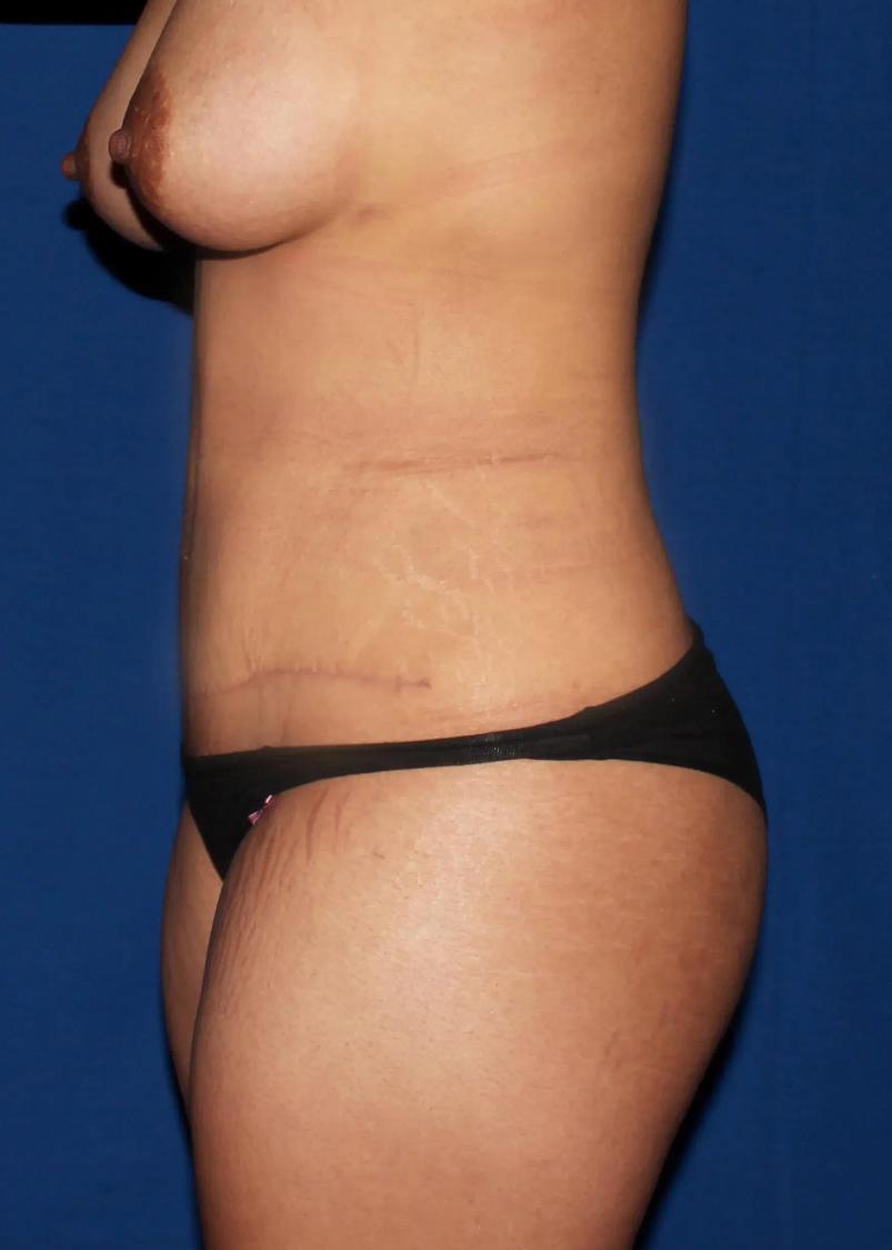 Front Liposuction (5L) (Same As Lipo360), view 3, after