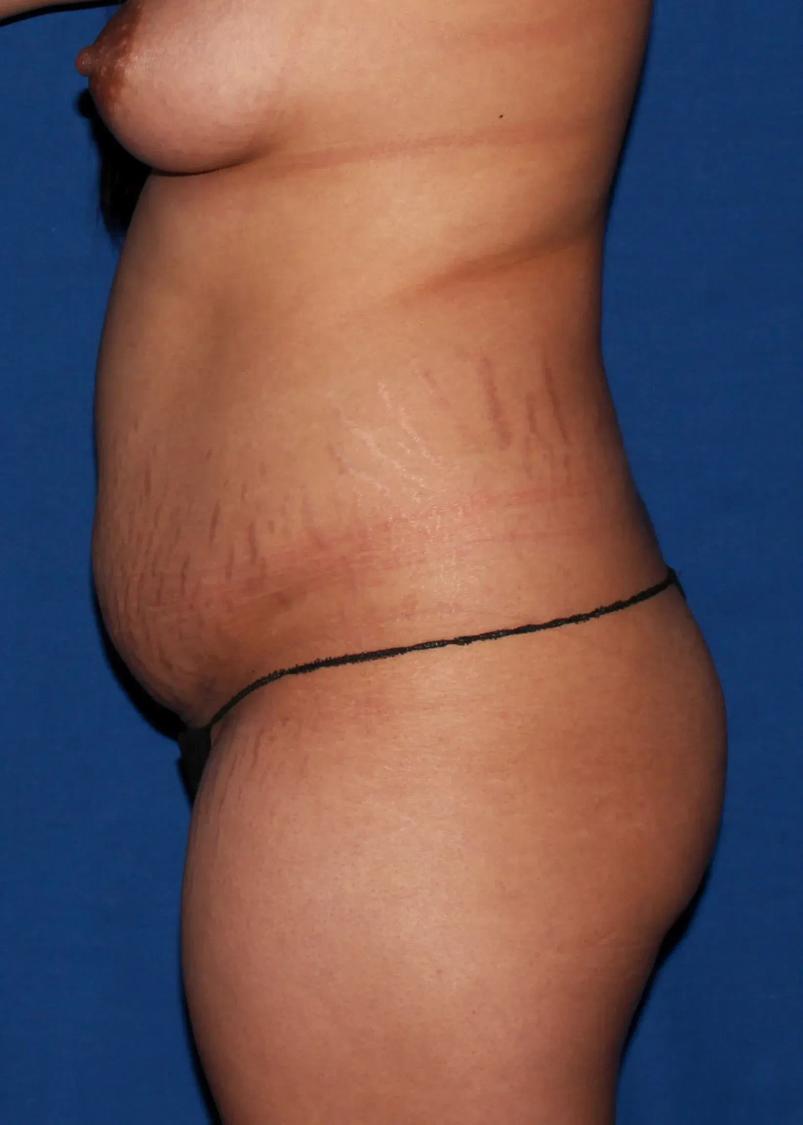 Front Liposuction (5L) (Same As Lipo360), view 3, before