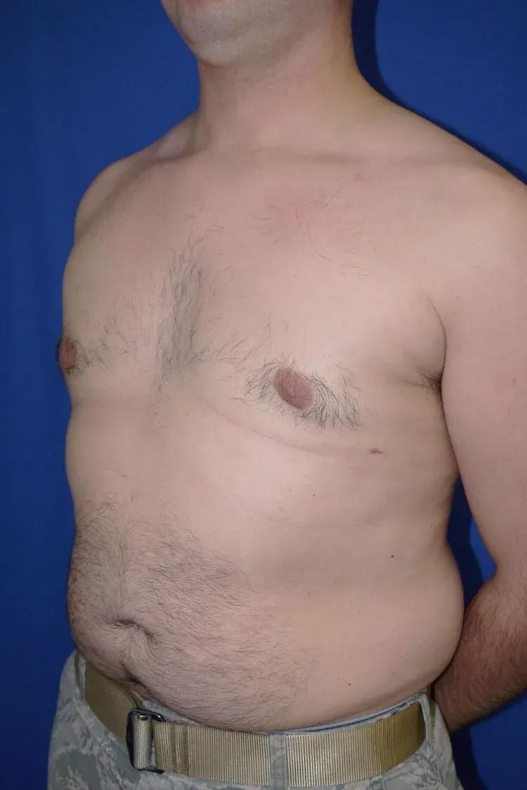 One-Stitch Gynecomastia after
