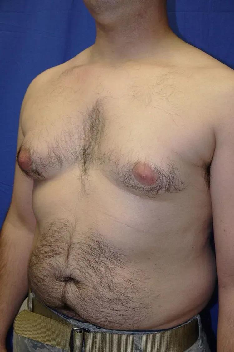 One-Stitch Gynecomastia before