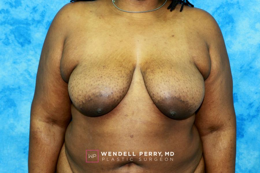 Fat Transfer To the Breast before