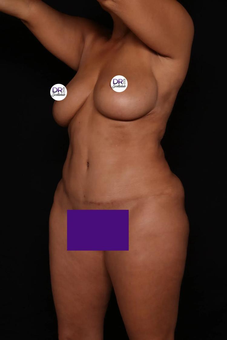 Front Liposuction (5L) (Same As Lipo360) after