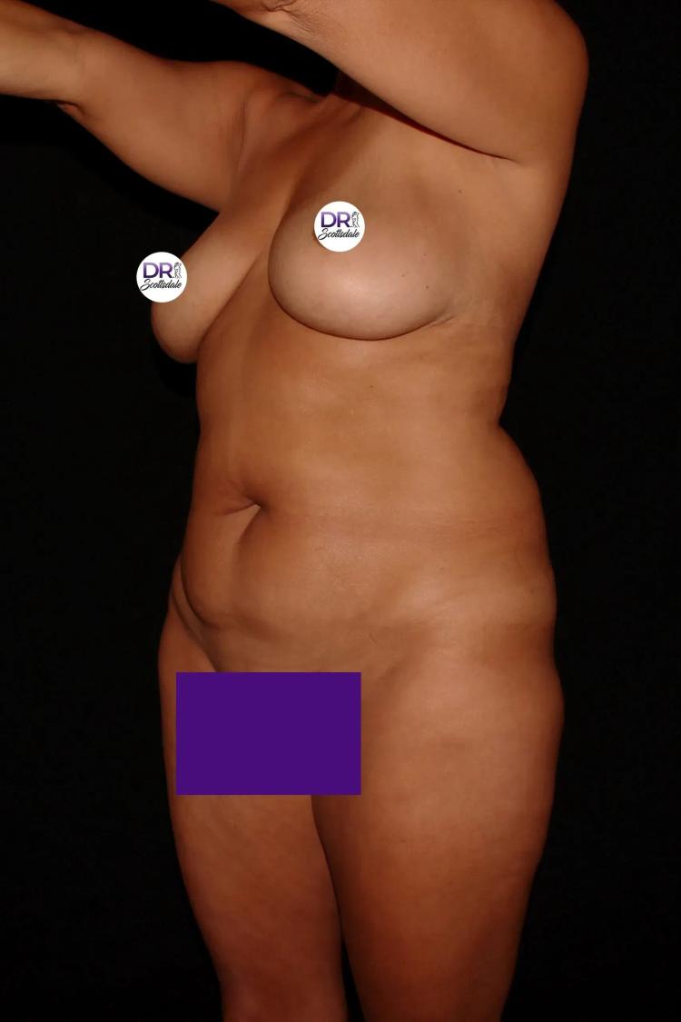 Front Liposuction (5L) (Same As Lipo360) before