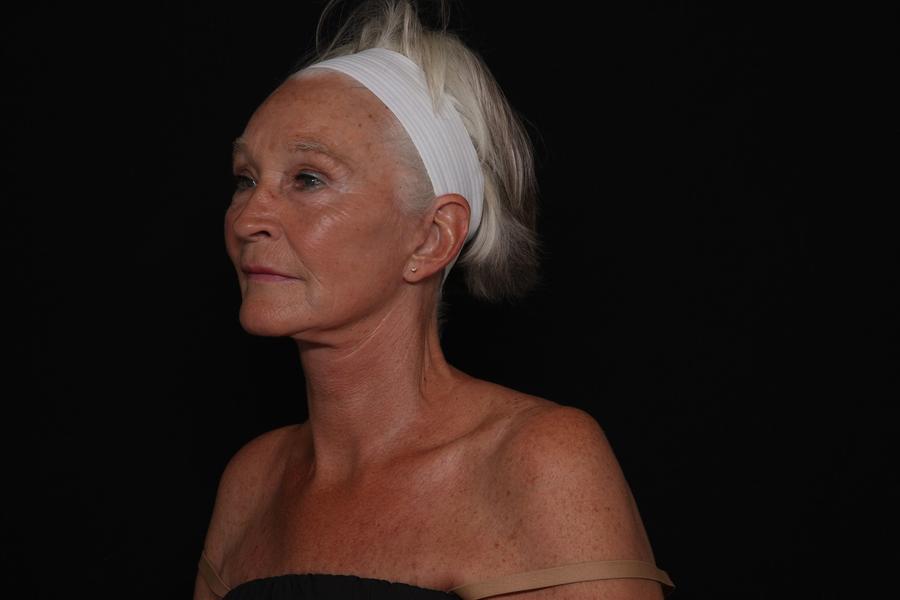 Facelift (neck lift included), view 3, after