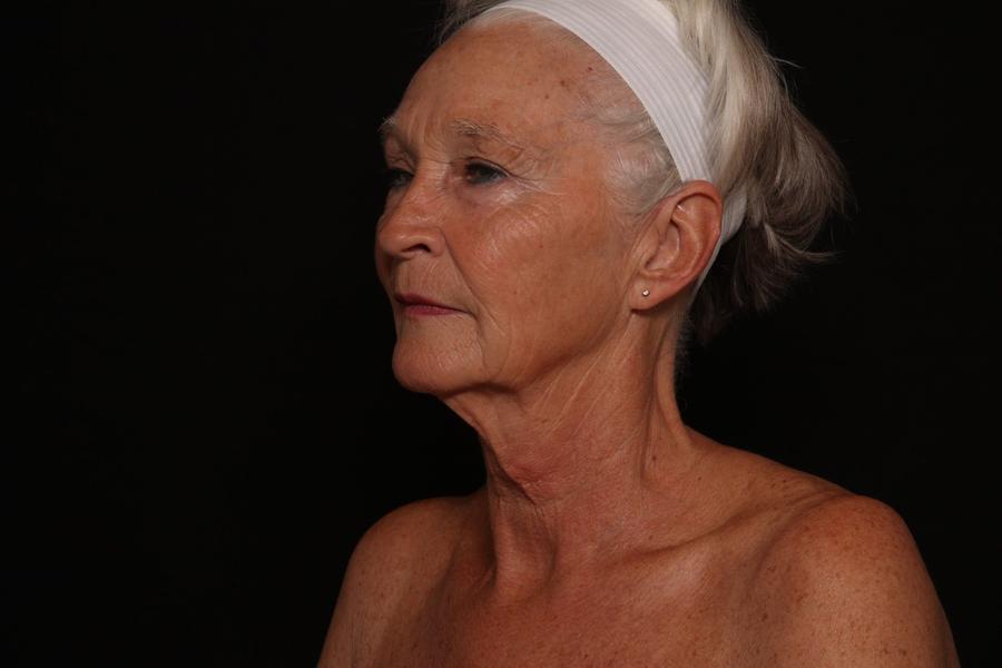 Facelift (neck lift included), view 3, before