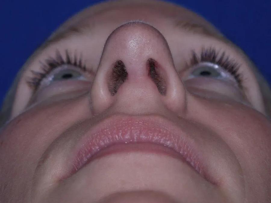 Rhinoplasty after