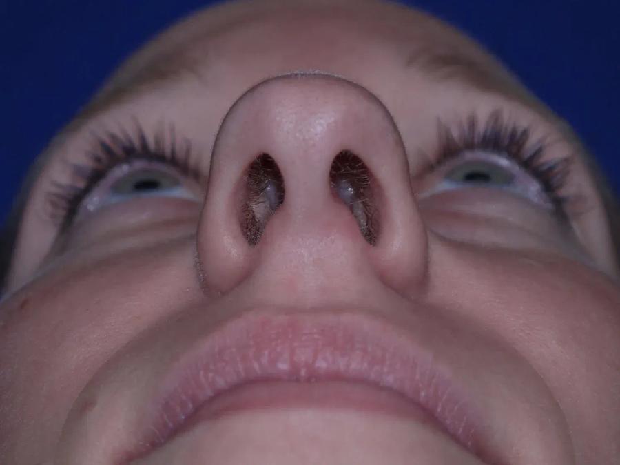 Rhinoplasty before