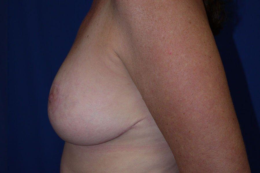 Breast Reduction, view 4, after