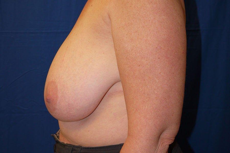 Breast Reduction, view 4, before