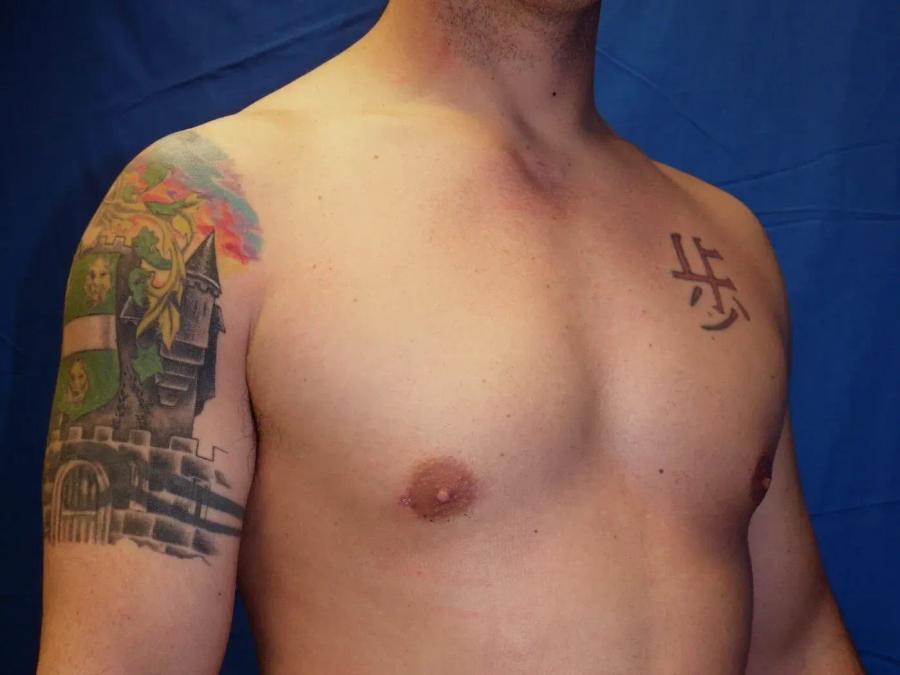 One-Stitch Gynecomastia after
