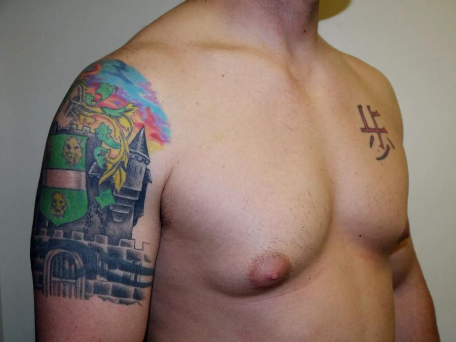 One-Stitch Gynecomastia before