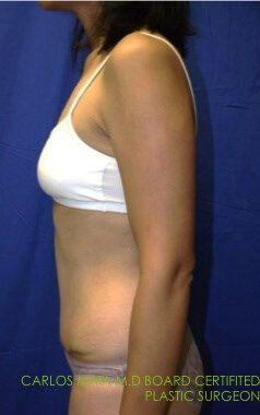 Tummy Tuck, view 4, after