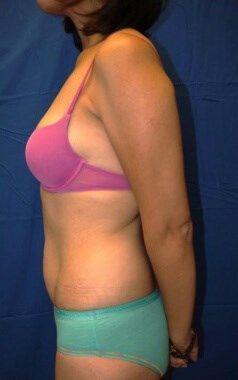 Tummy Tuck, view 4, before