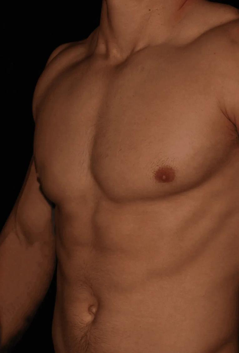 One-Stitch Gynecomastia after