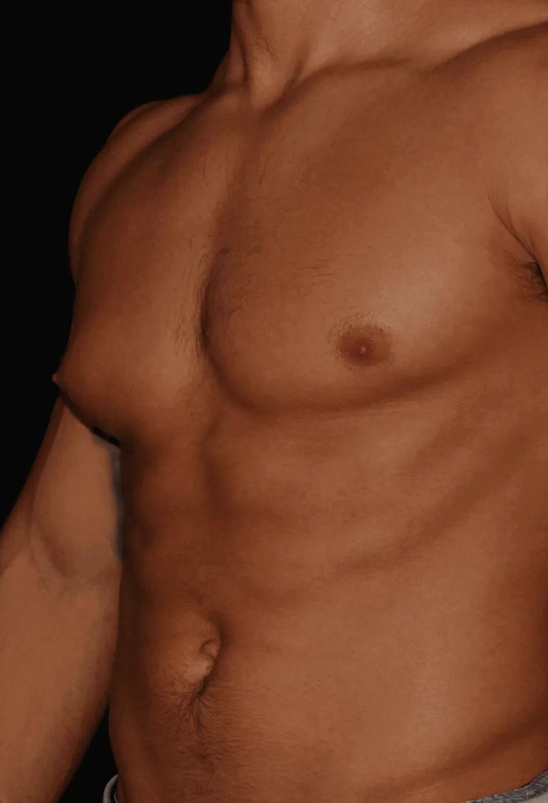 One-Stitch Gynecomastia before