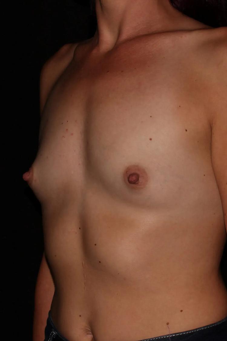 Breast Augmentation with Implants before