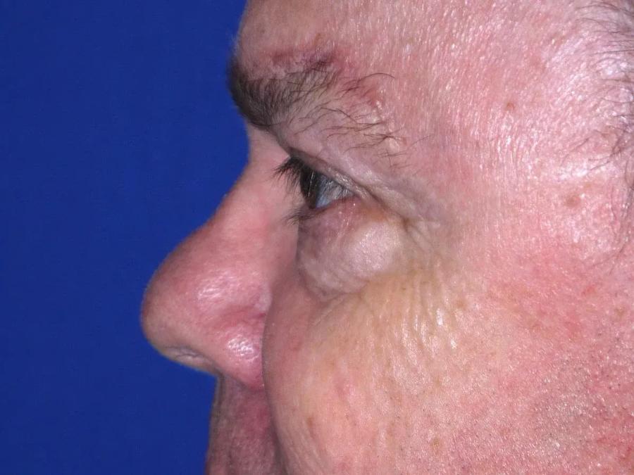 Facelift (neck lift included) after