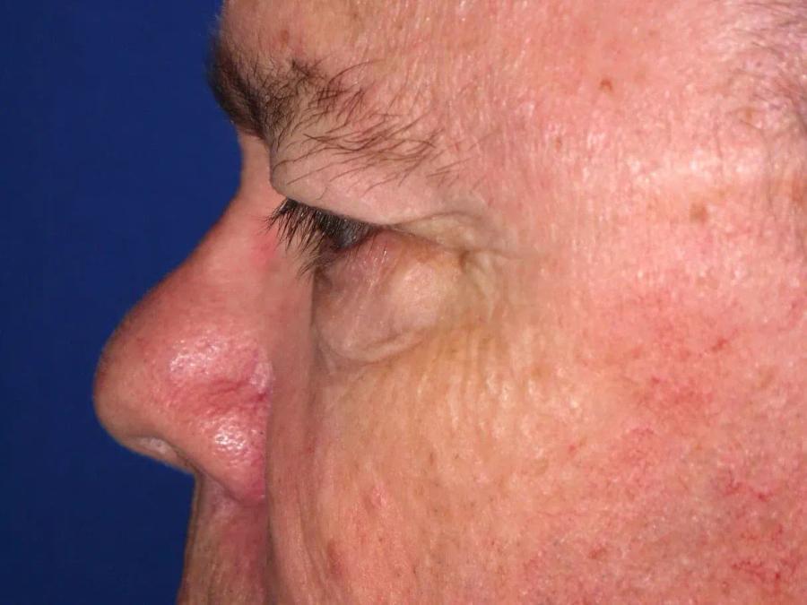 Facelift (neck lift included) before