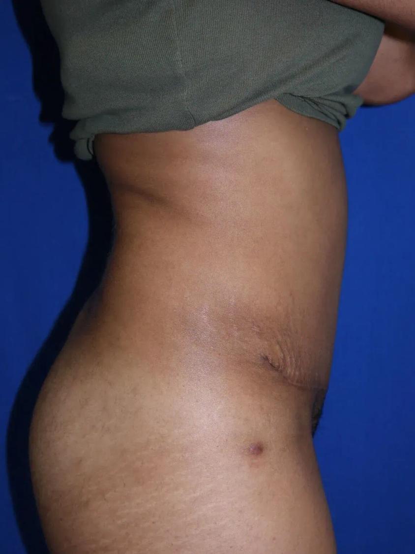 Tummy Tuck, view 3, after