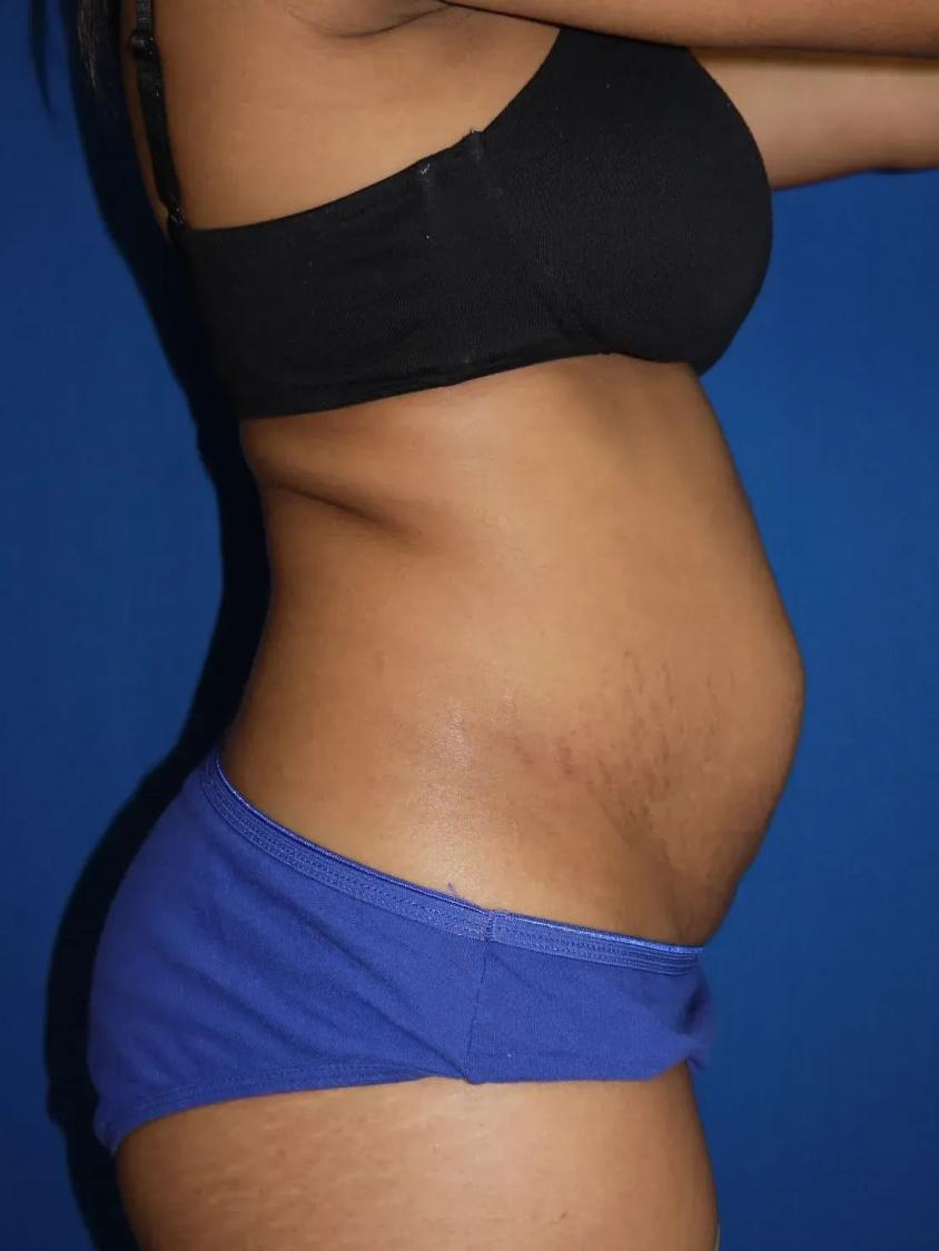 Tummy Tuck, view 3, before