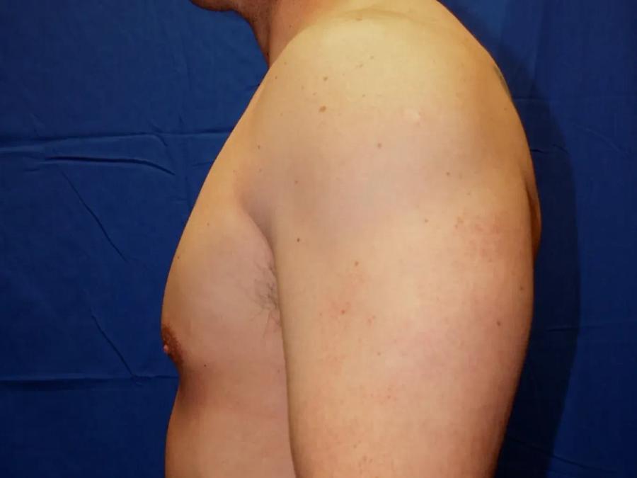 One-Stitch Gynecomastia, view 2, after
