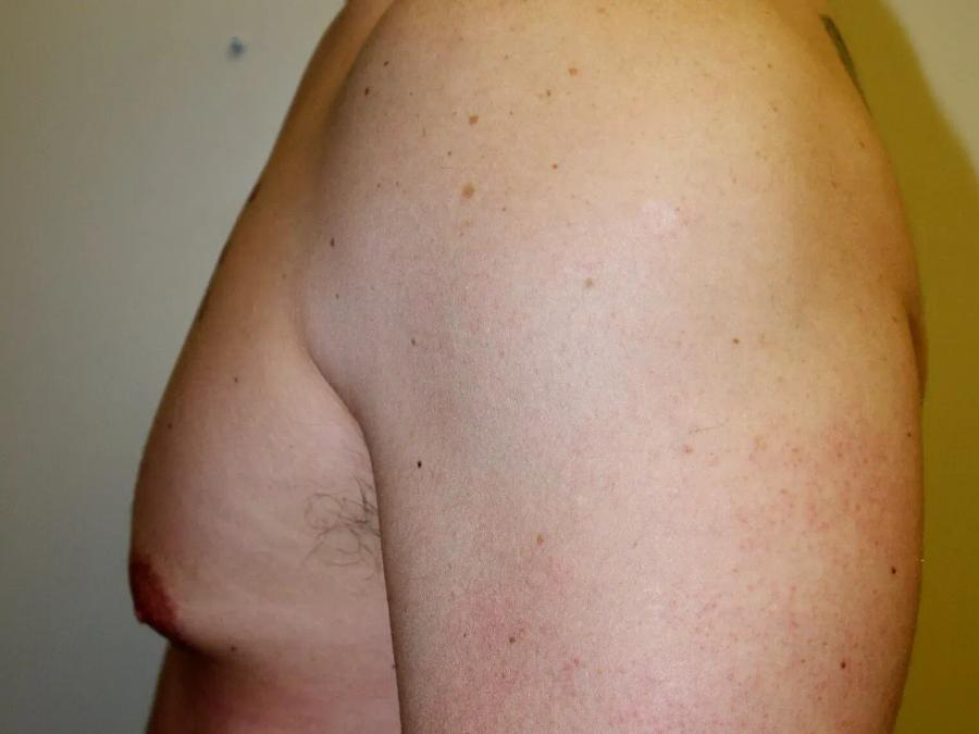 One-Stitch Gynecomastia, view 2, before