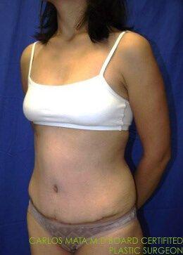 Tummy Tuck, view 2, after