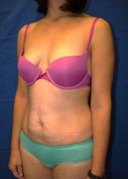 Tummy Tuck, view 2, before