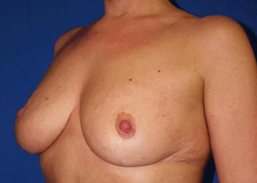 Breast Reduction after